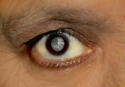 Cataract Eyes