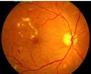 increased pressure affect the eye