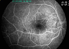 Fluorescein Angiography