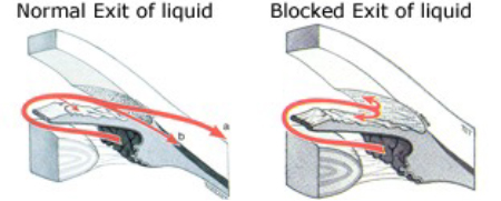 Cause of Glaucoma