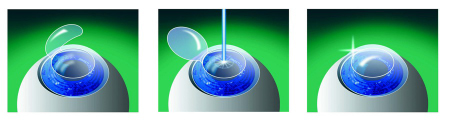 Lasik procedure