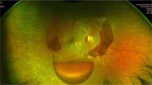 Optos Imaging
